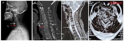 Case Report: Diagnosis of Primary Klebsiella pneumoniae in Cervical Spine by Metagenomic Next-Generation Sequencing